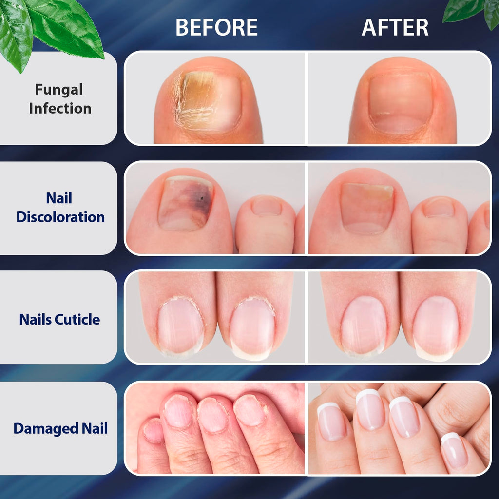 Tobcharm Toenail Fungus Treatment Extra Strength, Nail Fungus Treatment for Toenail, Fungus Nail Treatment, Nail Fungus Treatmen