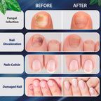 Tobcharm Toenail Fungus Treatment Extra Strength, Nail Fungus Treatment for Toenail, Fungus Nail Treatment, Nail Fungus Treatmen
