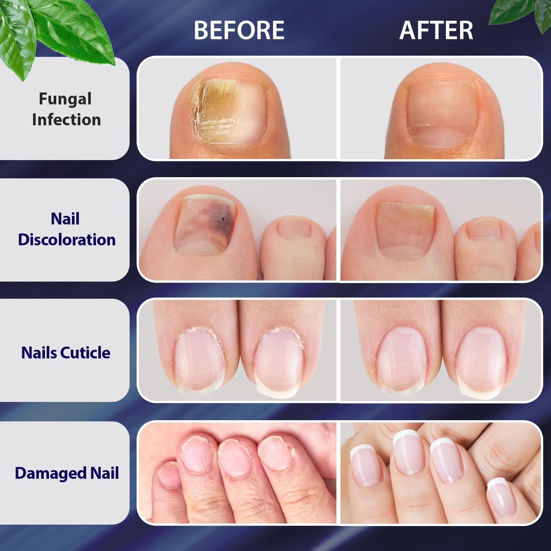Tobcharm Toenail Fungus Treatment Extra Strength, Nail Fungus Treatment for Toenail, Fungus Nail Treatment, Nail Fungus Treatmen