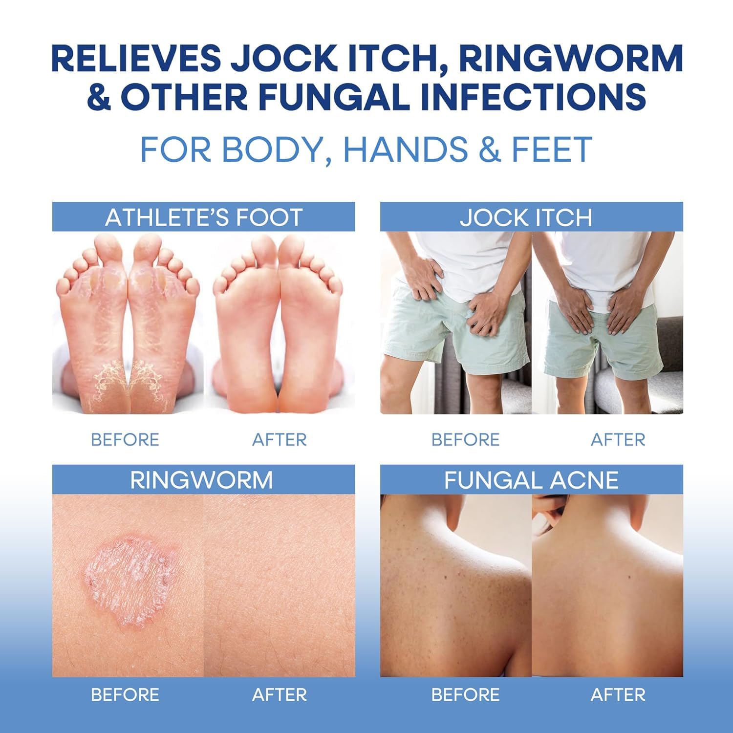 Hermon Folliculitis Treatment Cream & Antifungal Soap with Tea Tree Oil: Effective Treatment for Folliculitis Scalp Face and Bod