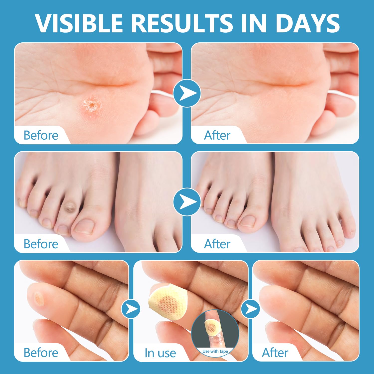 RHAICARE Corn removers for Toes feet Bottom of Foot Corn Remover,Corn Pads Callus Remover for Toes feet with 40% Salicylic 36 Co