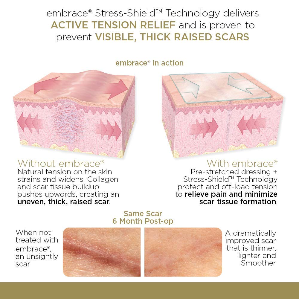 Embrace Active Scar Defense for New Scars, FDA-Cleared Silicone Scar Sheets, 6.3 Inch, X-Large, 30 Day Supply - Packaging May Va
