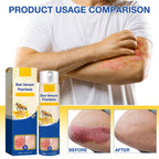 cuoct 2 PCS PsoriaHeal Bee Venom Psoriasis Treatment Spray, Psoriasis Relief Spray, Bee Venom Psoriasis Spray, Pure Natural Bee