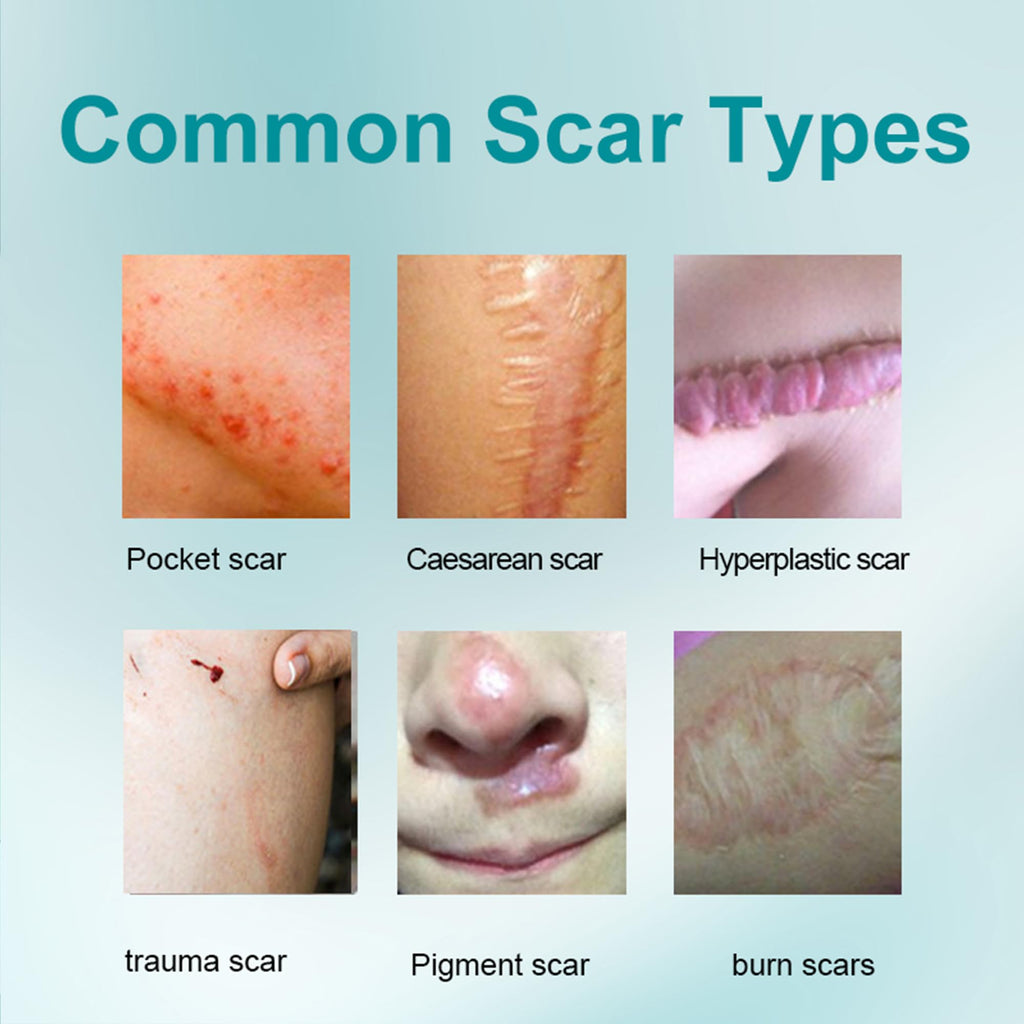 Silicone Scar Gel 20g, Effective Scar Cream - Reduces The Appearance of Both Old and New Scars from Burns, Injury, Acne, Stretch