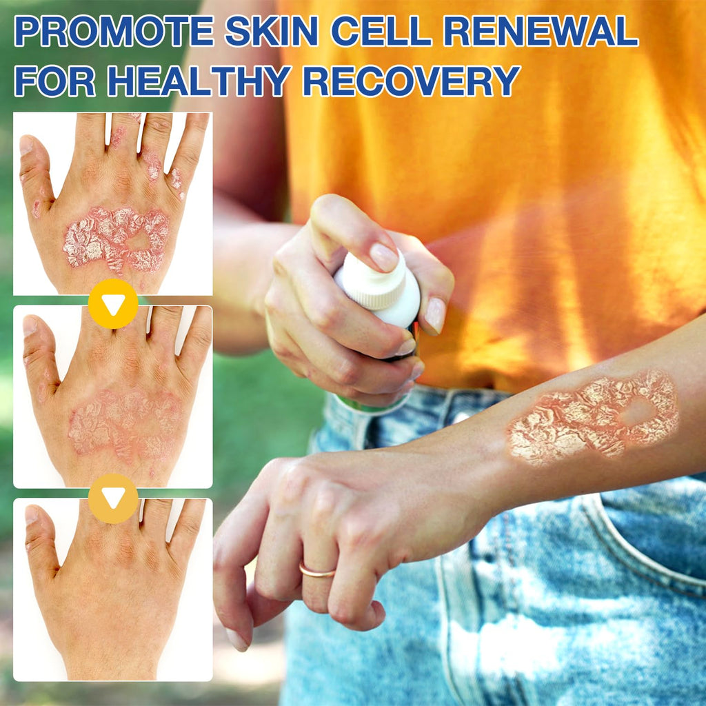 cuoct 2 PCS PsoriaHeal Bee Venom Psoriasis Treatment Spray, Psoriasis Relief Spray, Bee Venom Psoriasis Spray, Pure Natural Bee