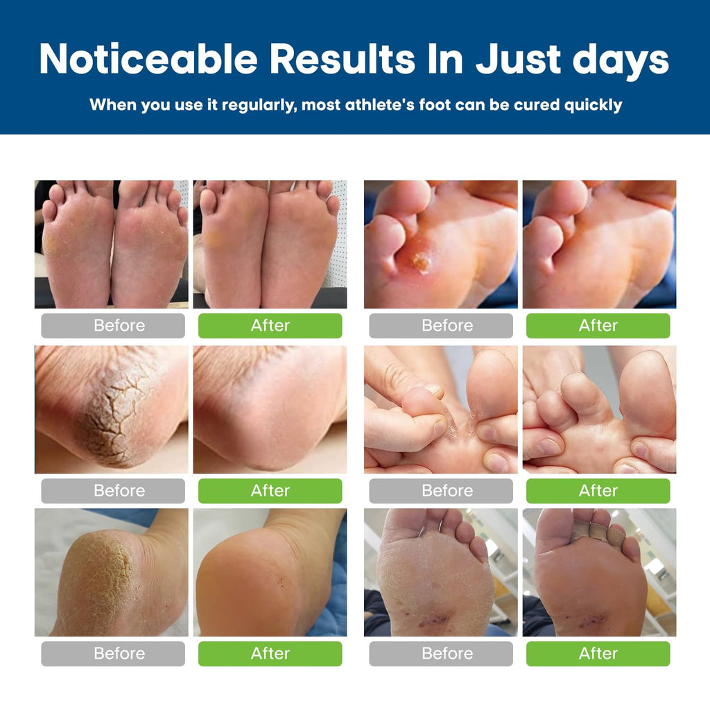 CHARMPOO Antifungal Cream for Foot and Body: Fast Relief Athletes Foot Jock Itch Psoriasis Ringworm Eczema Rashes - Powerful He