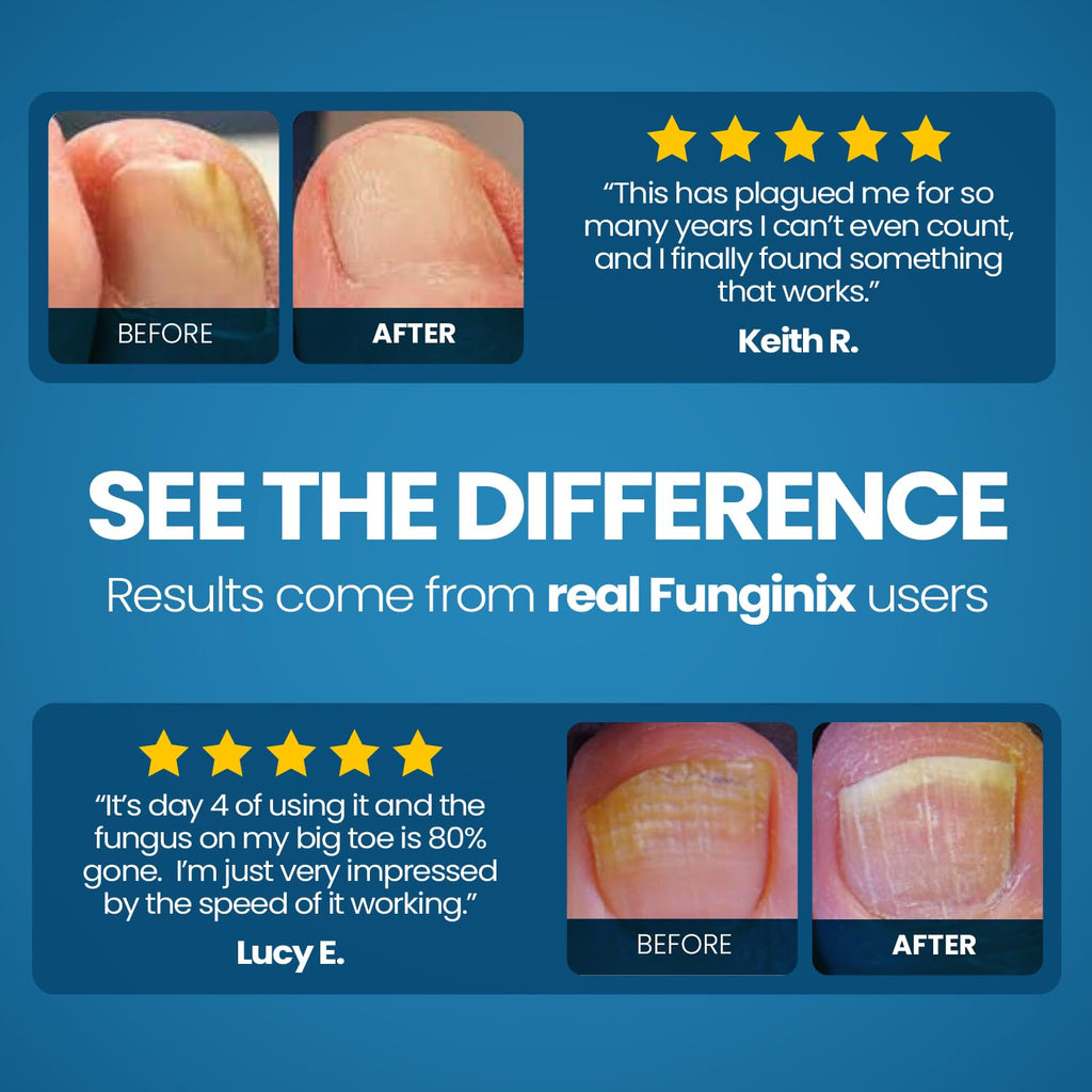 FUNGINIX Toenail Fungus Treatment - Maximum Strength - Nail Fungus Treatment & Athletes Foot Solution - Antifungal Liquid Solut