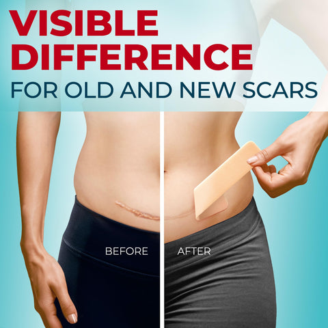 Medical Grade Silicone Scar Sheets - 6pk (5.7   x1.6   ) - Visible Difference on Surgical & Keloid Marks - Reusable C-Section Sc
