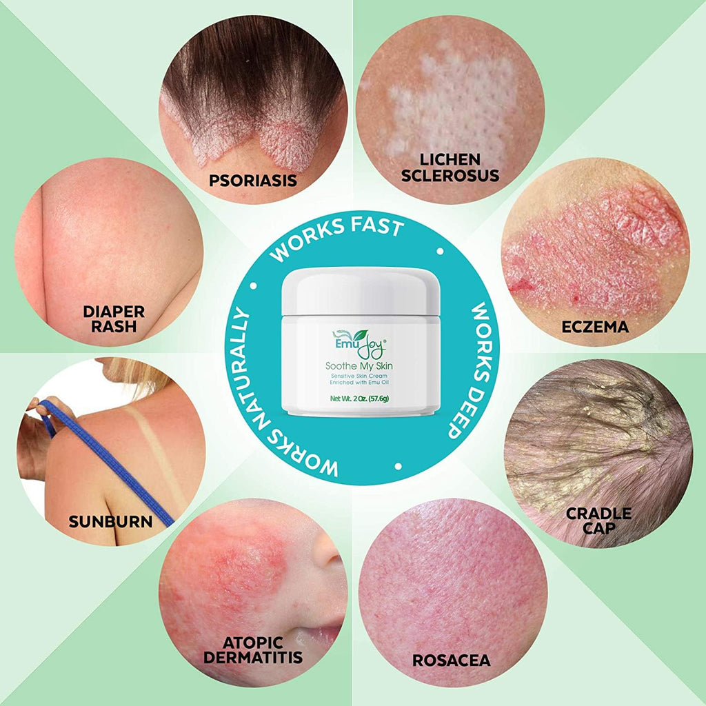 Soothe My Skin Cream for Sensitive Skin - Stocking Stuffers. Eczema Cream Psoriasis Atopic Dermatitis Lichen Sclerosus. Emu Oil