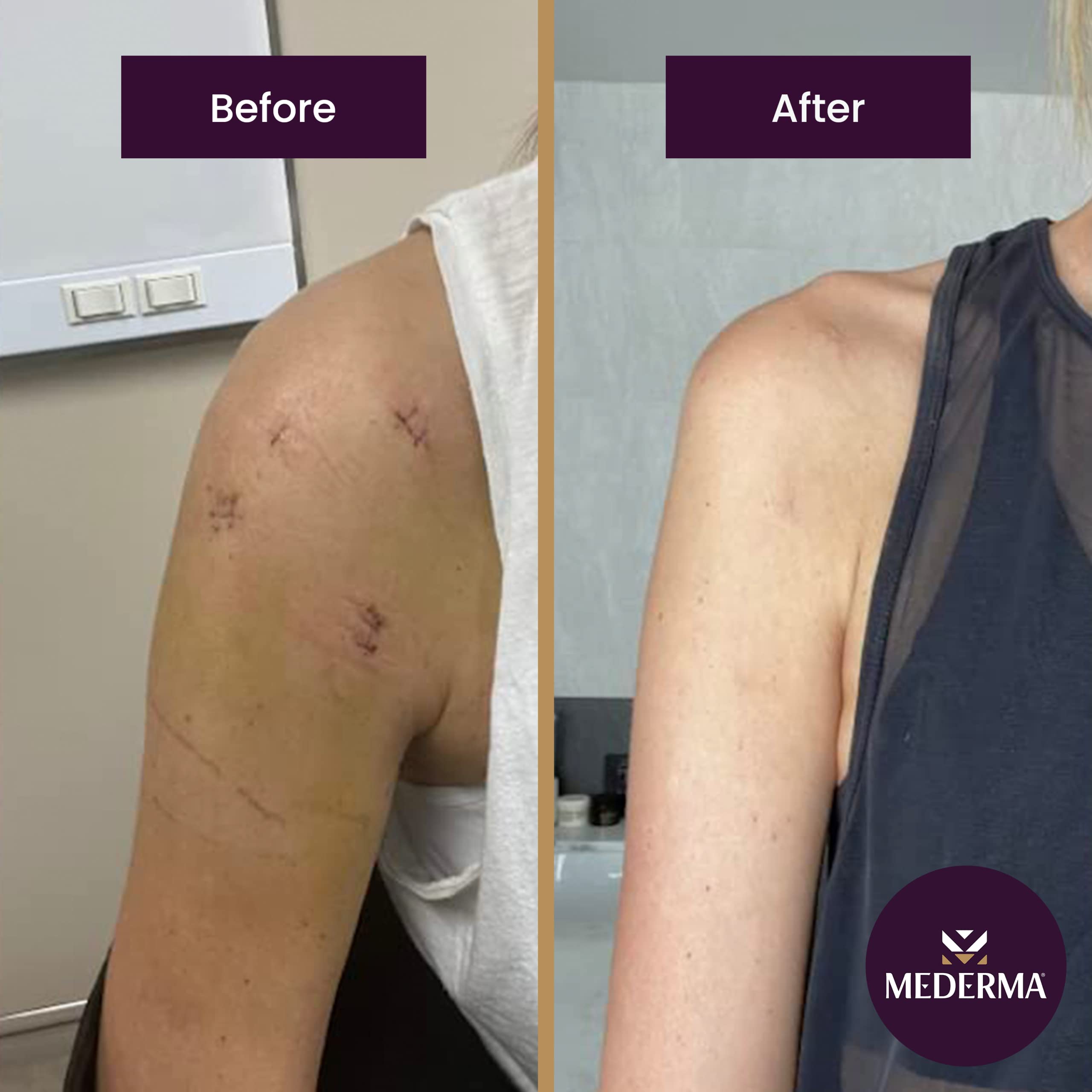 Mederma Advanced Scar Gel, Treats Old and New Scars, Reduces the Appearance of Scars from Acne, Stitches, Burns and More 1.76oz,