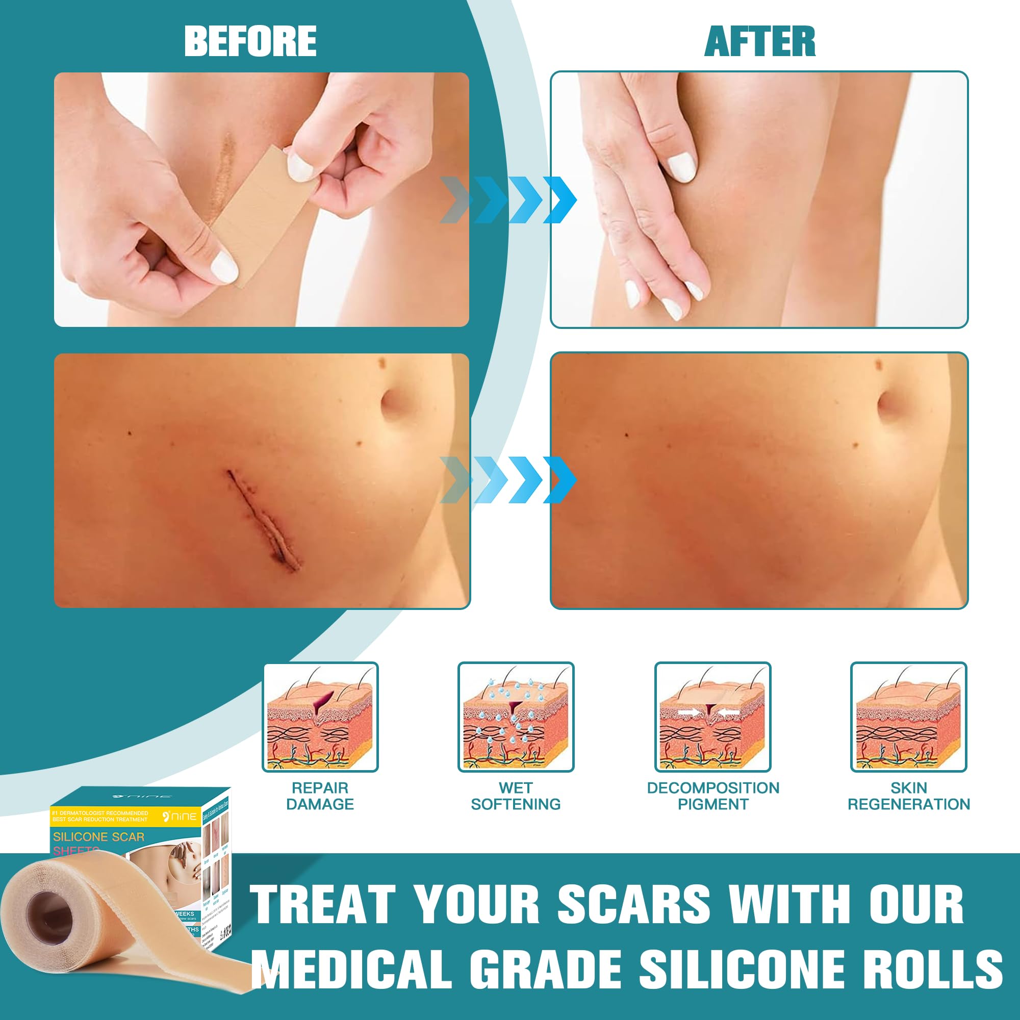 Silicone Scar Sheets,Silicone Scar Tape For Surgical Scars,0.55mm Thicked Silicone Scar Removal Strips For Surgical,C-Section,Tu