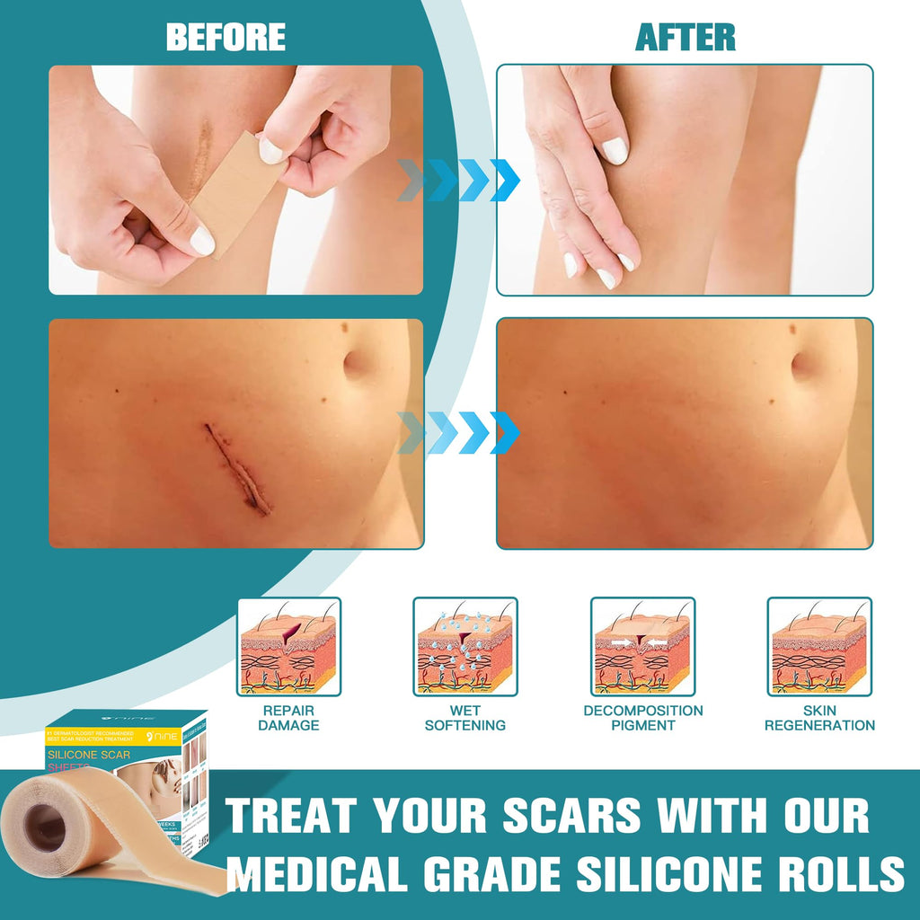 Silicone Scar Sheets,Silicone Scar Tape For Surgical Scars,0.55mm Thicked Silicone Scar Removal Strips For Surgical,C-Section,Tu
