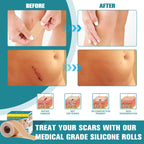 Silicone Scar Sheets,Silicone Scar Tape For Surgical Scars,0.55mm Thicked Silicone Scar Removal Strips For Surgical,C-Section,Tu
