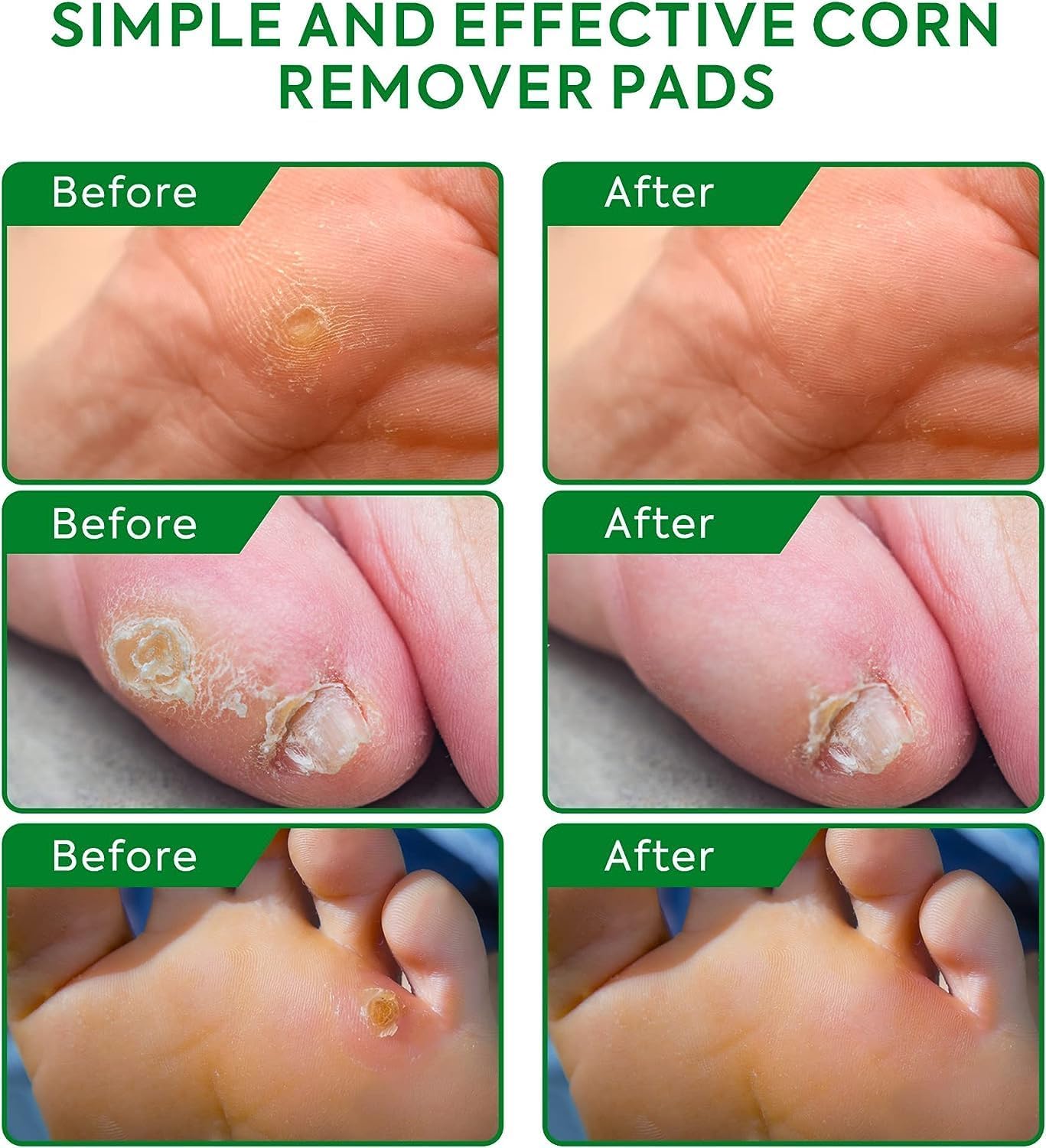Corn Removers for Toes Feet Bandages: Corn Cushions and Small Callus Removal with 40% Salicylic Acid Long Adhesive - for Adult S