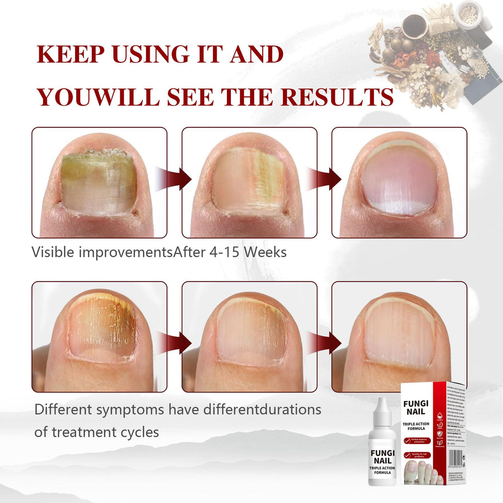 Toenail Fungus Treatment, Herbal Extracts, Nighttime Long-Lasting Nail Treatment, Suitable for Discoloration, Shaped Nails, Thic