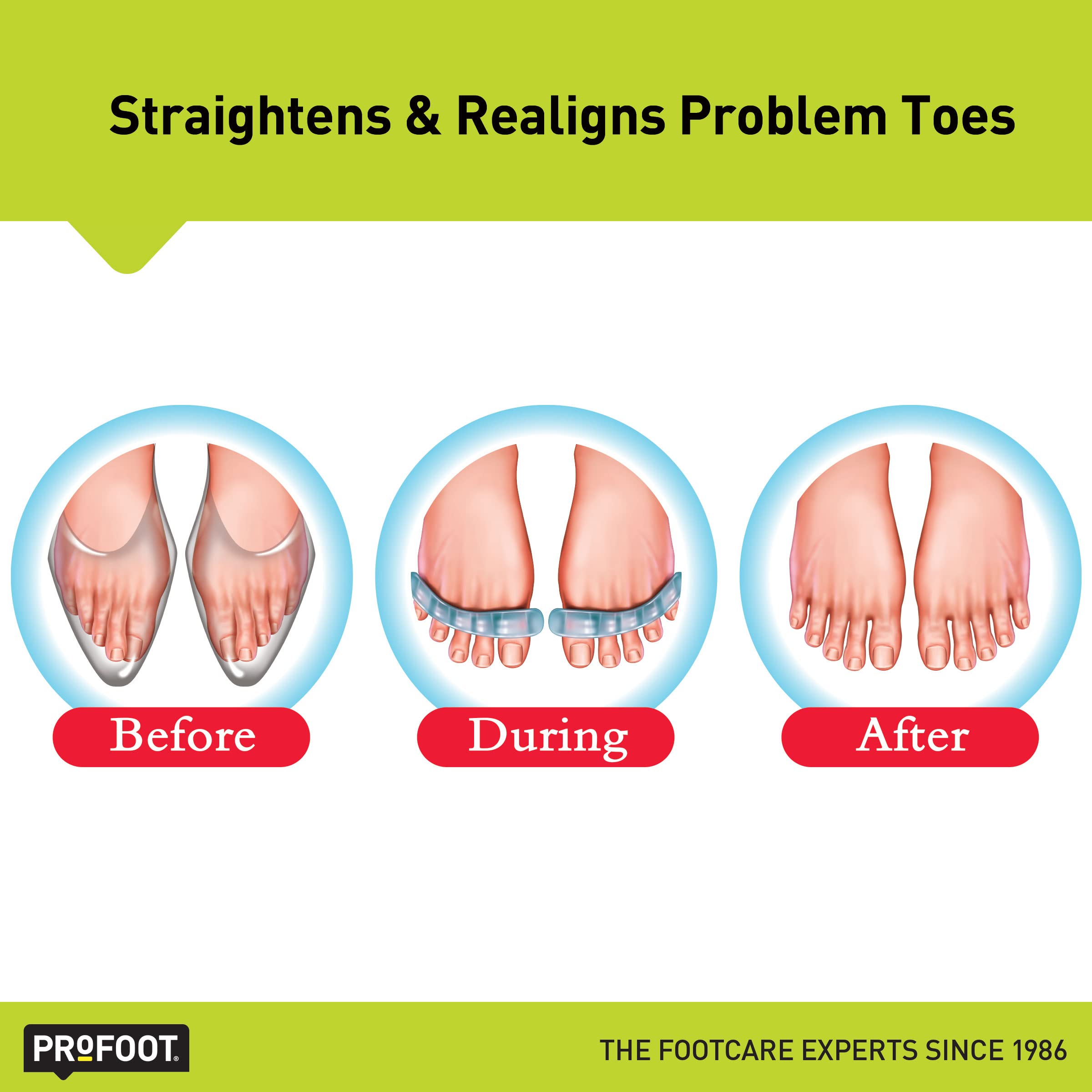 PROFOOT Flex-tastic Toe Spacers, Gel Toe Separators for Foot Pain, Bunions, Overlapping & Hammer Toes, Helps Restore Alignment &