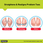 PROFOOT Flex-tastic Toe Spacers, Gel Toe Separators for Foot Pain, Bunions, Overlapping & Hammer Toes, Helps Restore Alignment &