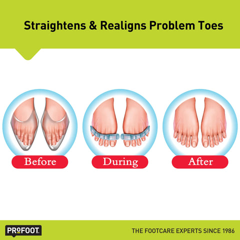 PROFOOT Flex-tastic Toe Spacers, Gel Toe Separators for Foot Pain, Bunions, Overlapping & Hammer Toes, Helps Restore Alignment &