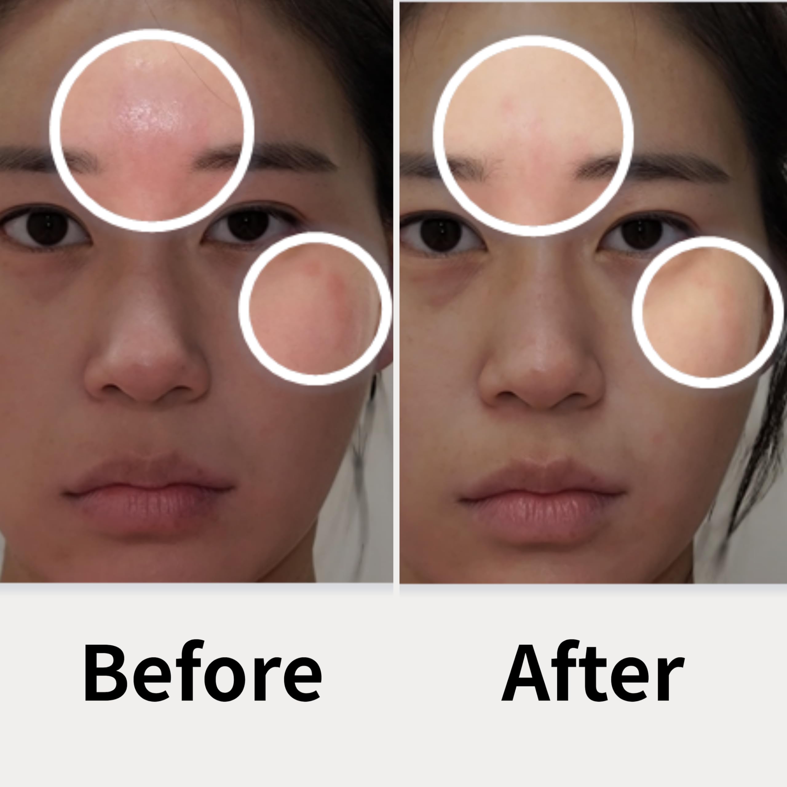 AD SOLUTION Ato Fast Calming Patch for Skin Redness, Itching & Flare-Ups - Soothing Hydrogel for Sensitive Skin with Cica & Pant
