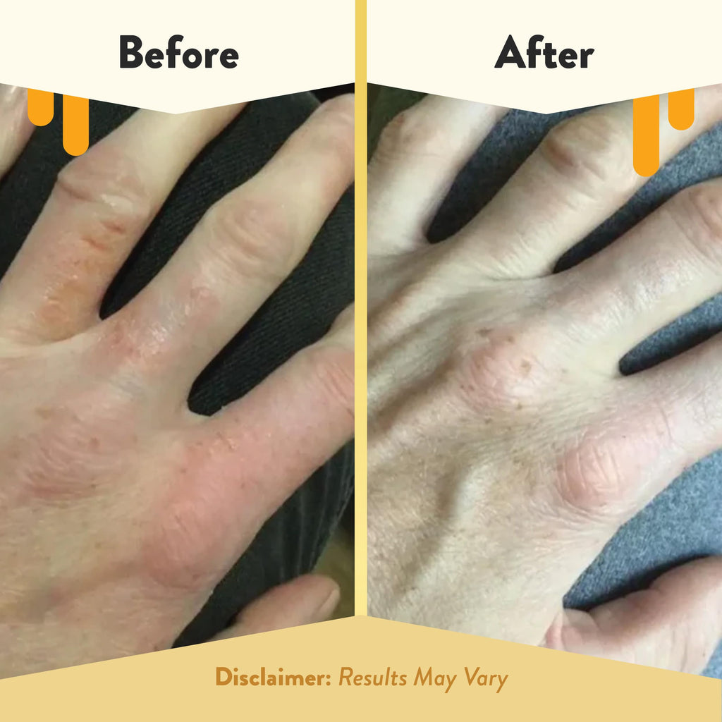 ECZEMA HONEY Oatmeal Hand Cream - Natural Hand & Body Lotion for Eczema Rash Relief - Eczema Cream for Dry, Itchy, Sensitive, &