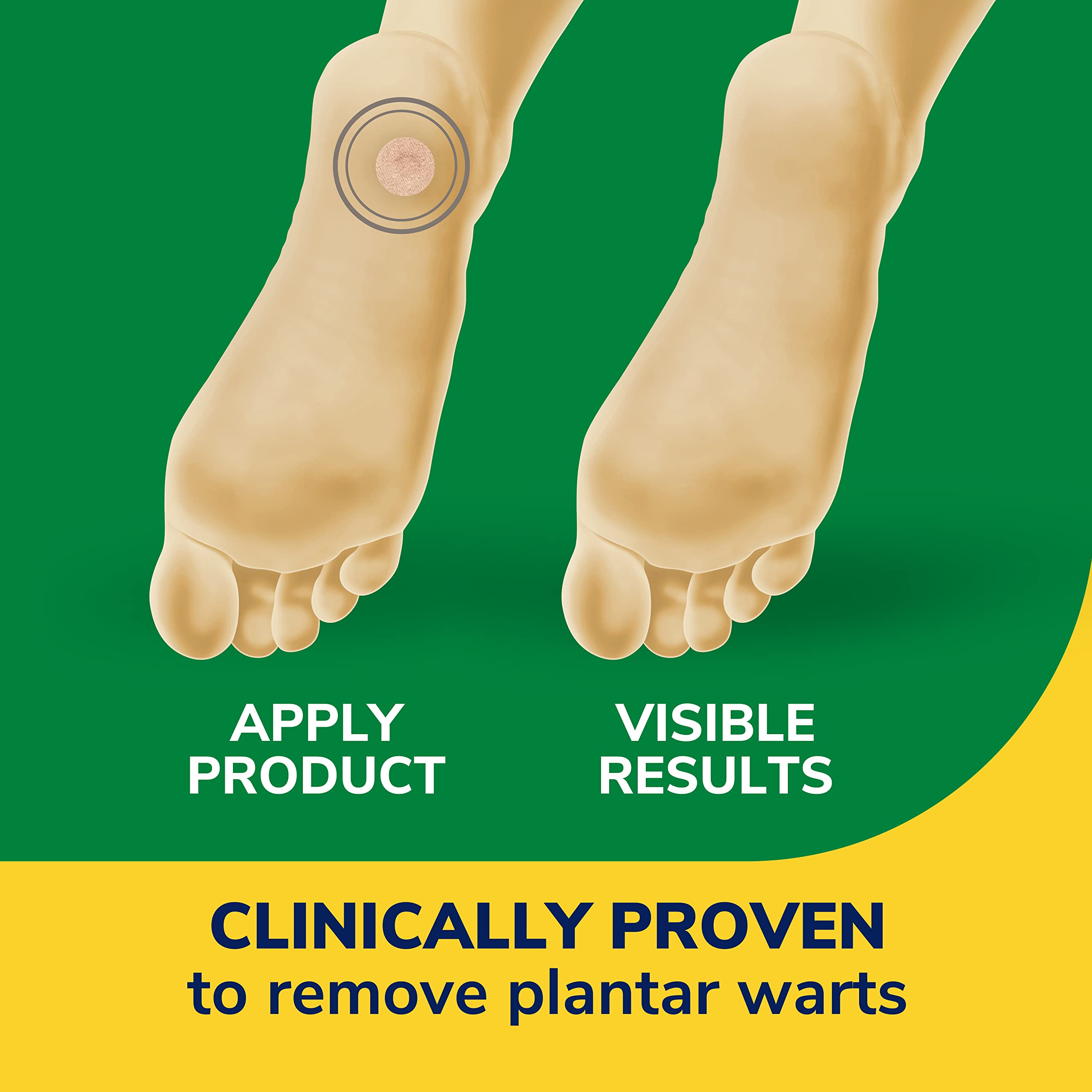 Dr. Scholl 's Clear Away Plantar WART Remover // 24 Discs/24 Cushions, Clinically Proven, Maximum Strength Without a Prescriptio