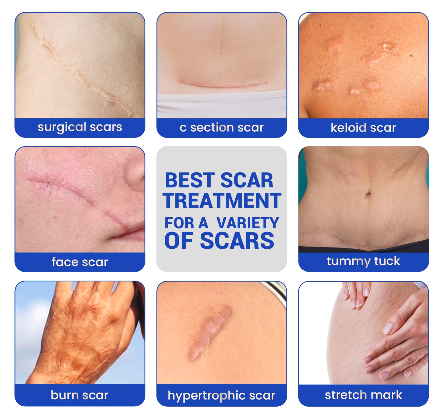 Silicone Scar Sheets Surgical Tape (1.6   x120    Roll) Face Patches Acne Treatment C Section Strips, Skin-Sensitive Medical Gra