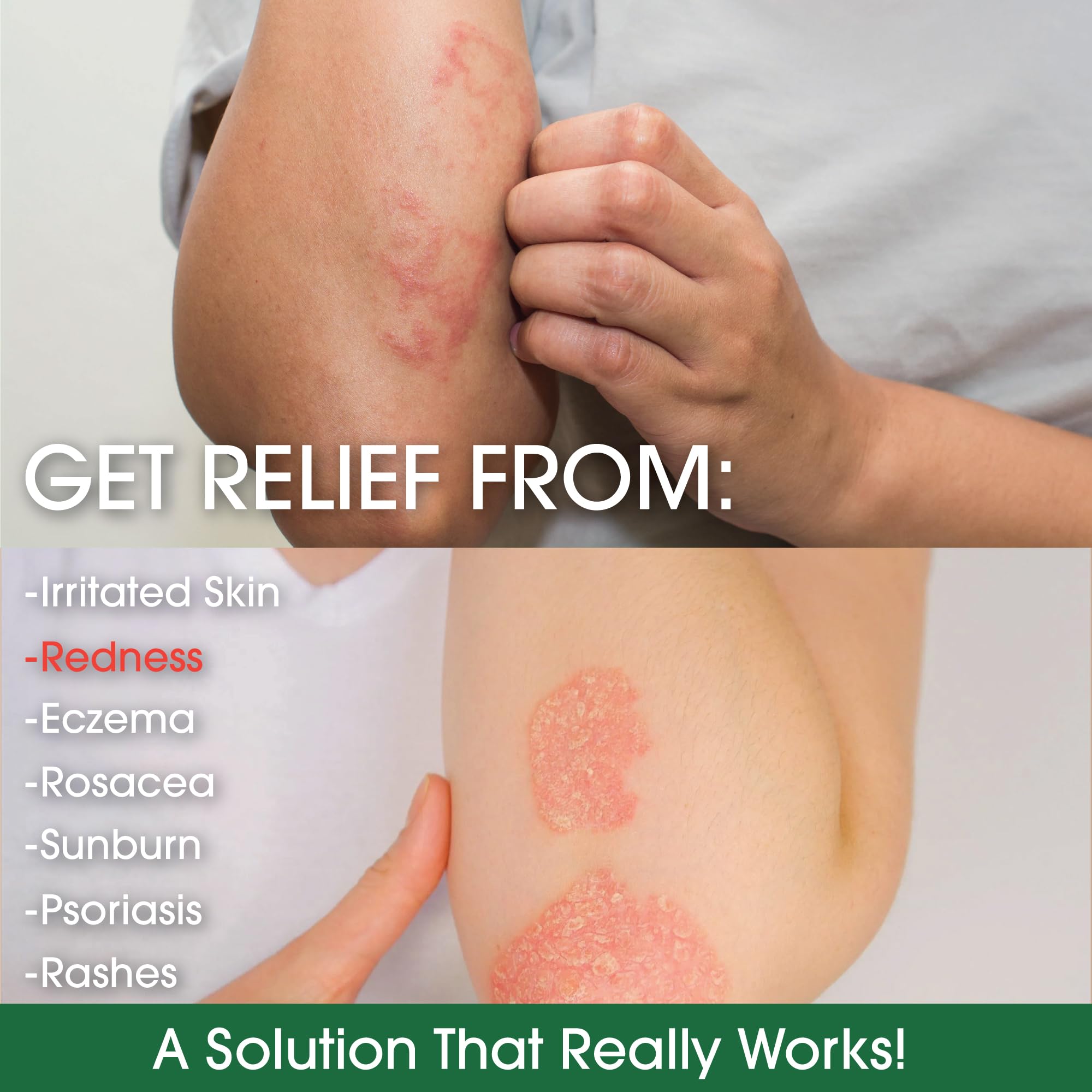 Manuka Honey Eczema Cream Moisturizing Lotion for Psoriasis Relief - Itchy, Dry Skin Rash Ointment - Soothing Moisturizer for Ba