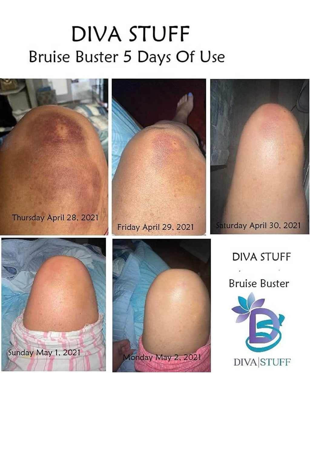 Bruise Buster Cream By Diva Stuff 4oz, 2 pack