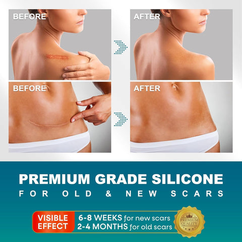 Silicone Scar Sheets, Silicone Scar Tape(1.6''x 120'' Roll-300CM), Silicone Tape for Scars, Scar Tape for Surgical Scars, Silico