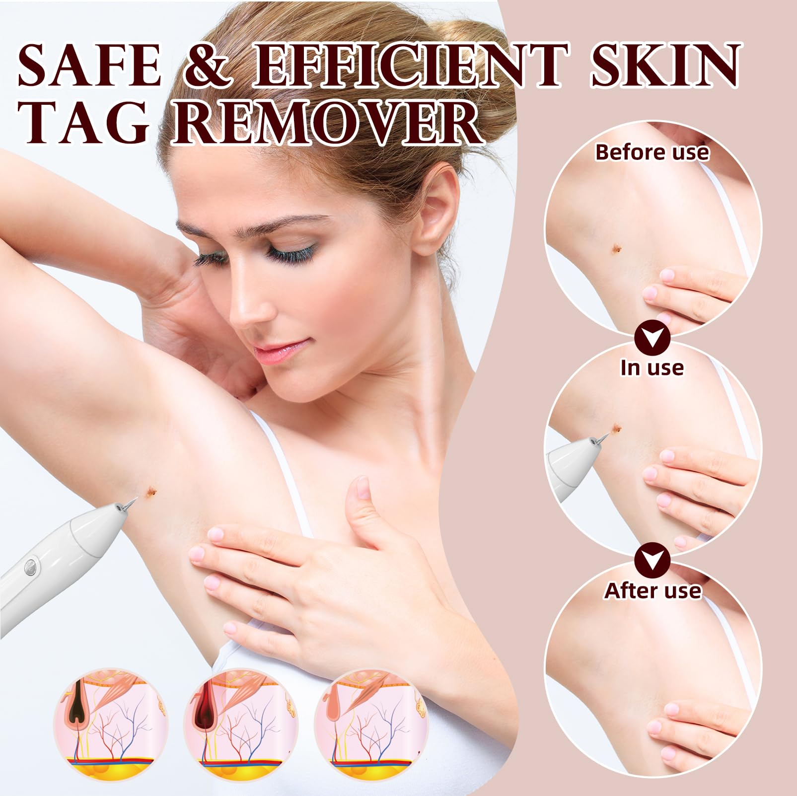 Breaspec LM 1000 SkinTag Remover Home Use, Removal of Common Warts, SkinTags | Easy to Use