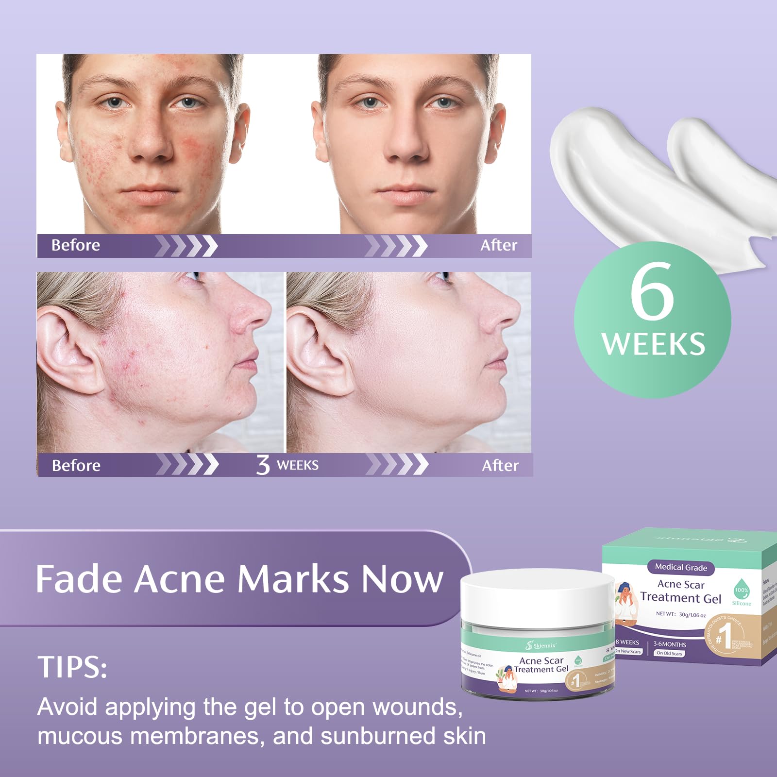 Skiennix Acne Scar Treatment for Face, Advanced Scar Gel, Treats Old and New Scars, Reduces the Appearance of Scars for Face Acn