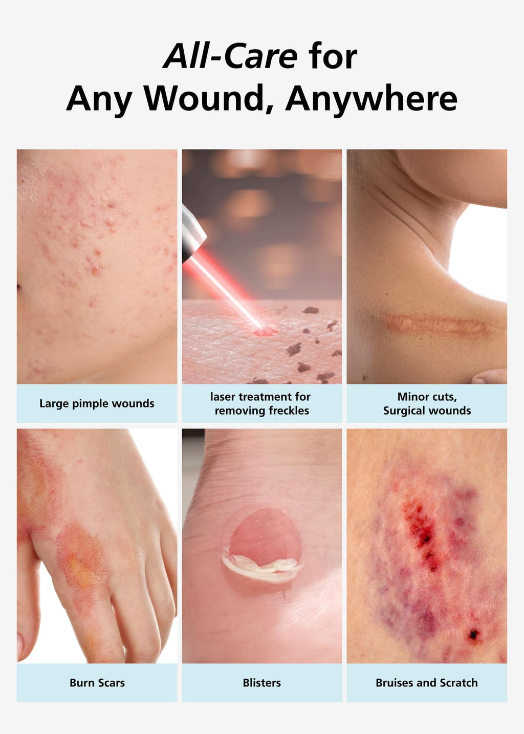 Easyderm Thin Hydrocolloid Large Wound Dressing 4   x4    3Pack (6 Dressings) Waterproof, Latex Free, Highly Absorbent Dressing