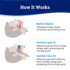 ZQuiet Anti-Snoring Mouthpiece Solution, 2 Size Comfort System Starter Kit + Nasal Dilator (2 Pack / 30 Day Supply) - Made in US