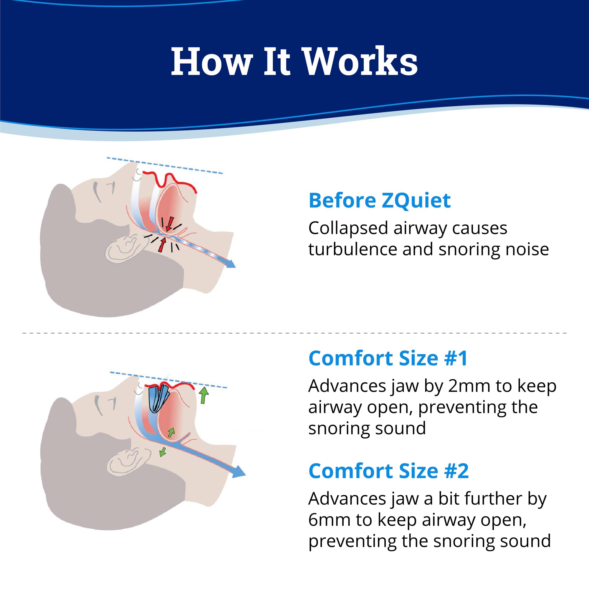 ZQuiet Anti-Snoring Mouthpiece Solution, 2 Size Comfort System Starter Kit + Nasal Dilator (2 Pack / 30 Day Supply) - Made in US