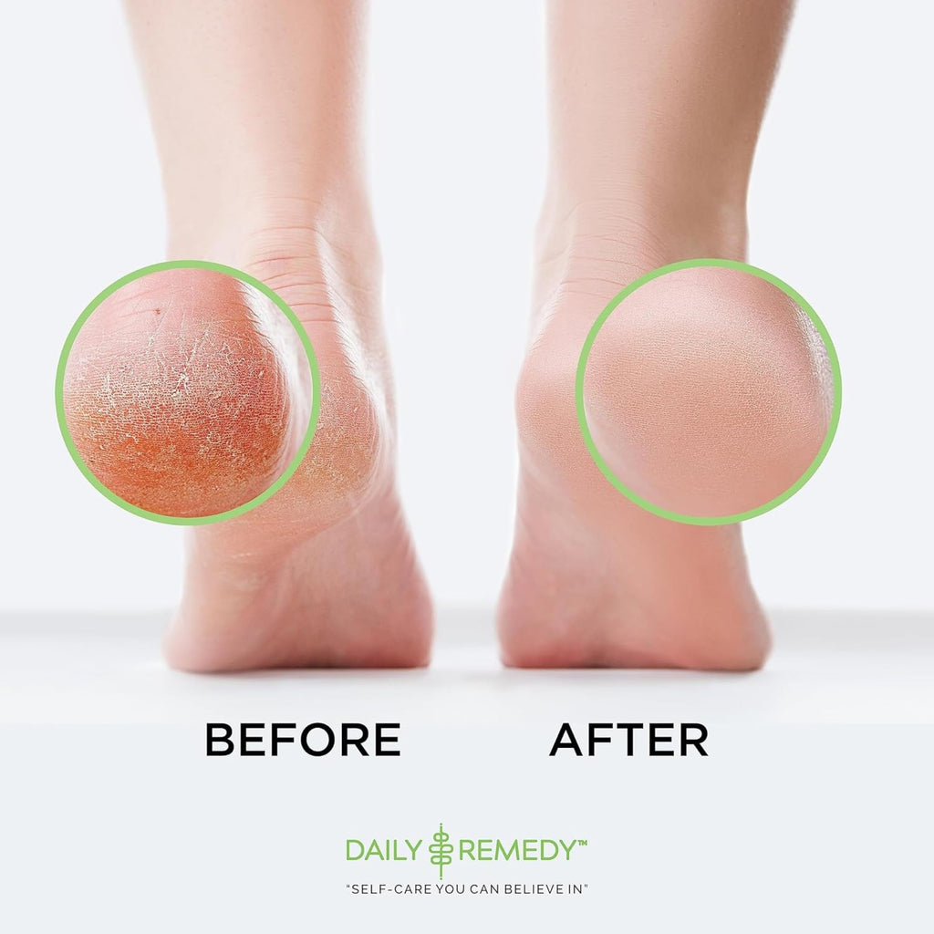 Callus Remover Gel - Professional Foot Callus Removal for Smooth Feet & Cracked Heels - Extra Strength Callus Gel with Pumice St