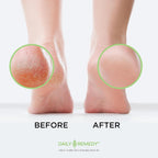Callus Remover Gel - Professional Foot Callus Removal for Smooth Feet & Cracked Heels - Extra Strength Callus Gel with Pumice St
