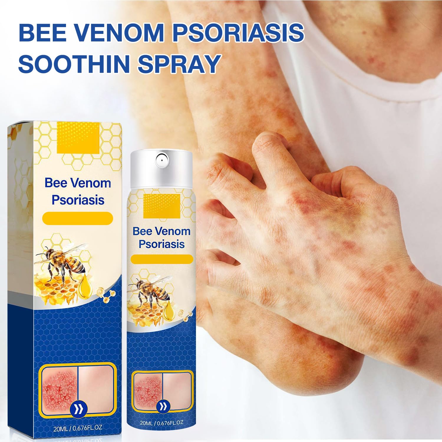 cuoct 2 PCS PsoriaHeal Bee Venom Psoriasis Treatment Spray, Psoriasis Relief Spray, Bee Venom Psoriasis Spray, Pure Natural Bee