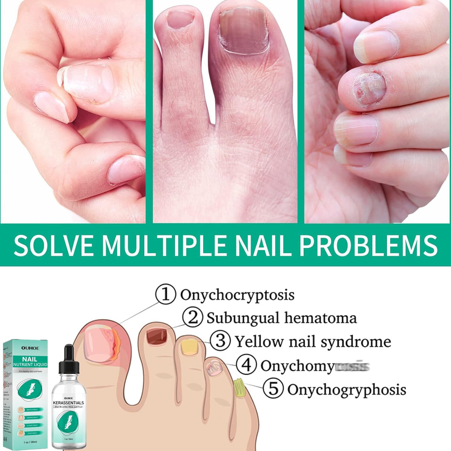 Kerassentials Nails Nutrient Oil,Kerassentials Toenail Oil,Nail Repair Solution,Nail Renewal Liquid For Damaged & Discoloration