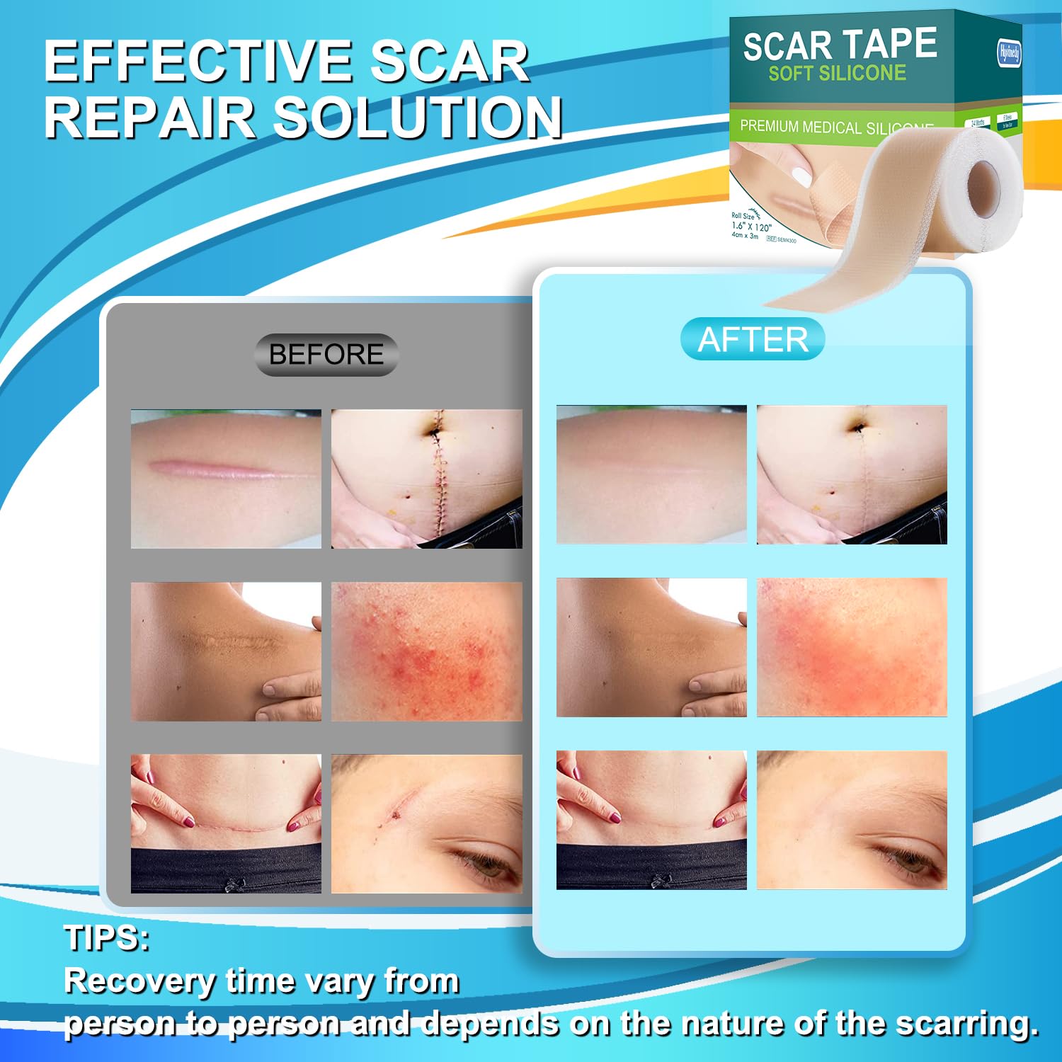 Medical Grade Silicone Scar Tape for Surgical Scars (1.6'' x 120'' - 3M) Professional Silicone Scar Sheets Scar Treatment for Fa