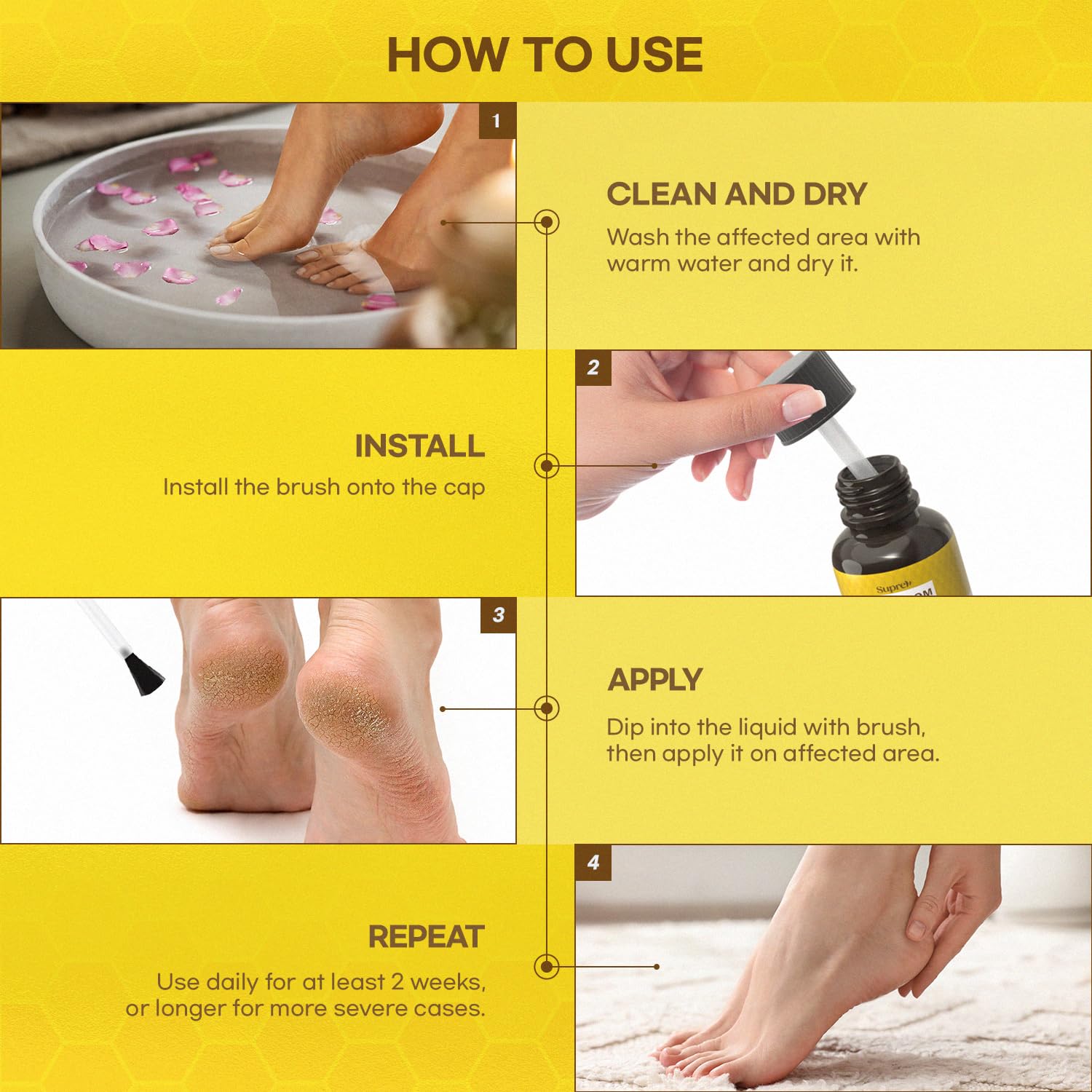 SupreH Fast-Acting bee Venom wart Remover: wart Freeze Off with salicylic Acid & bee Venom Cream - Wart Removal for Plantar Wart