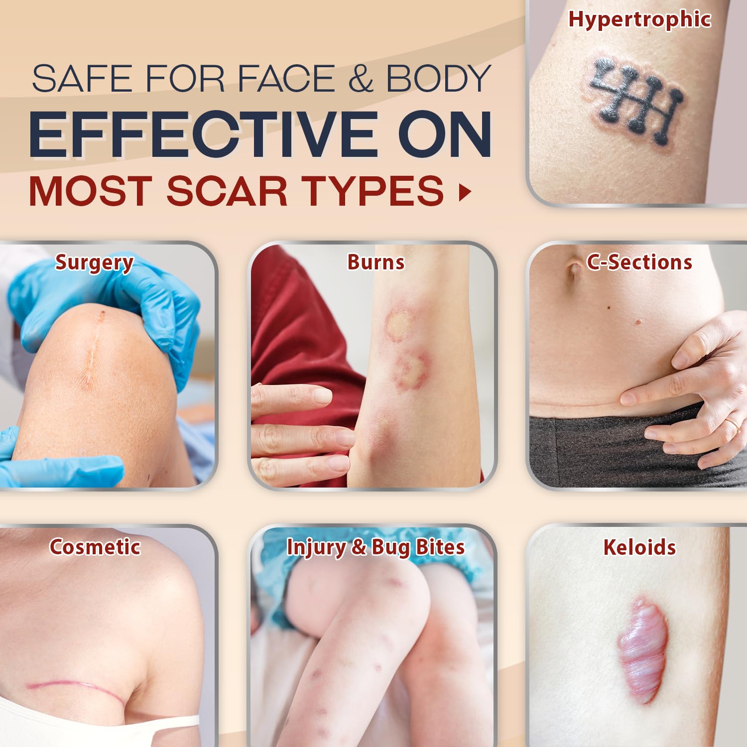 Ebanel Advanced Silicone Scar Gel with Onion Extract, Allantoin, Emu Oil, Vitamin E, Medical-Grade Scar Cream for Old & New Scar