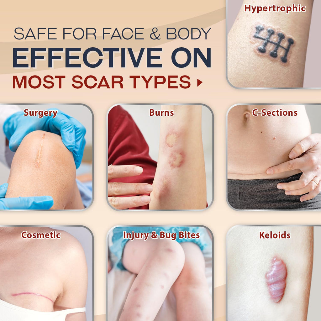 Ebanel Advanced Silicone Scar Gel with Onion Extract, Allantoin, Emu Oil, Vitamin E, Medical-Grade Scar Cream for Old & New Scar