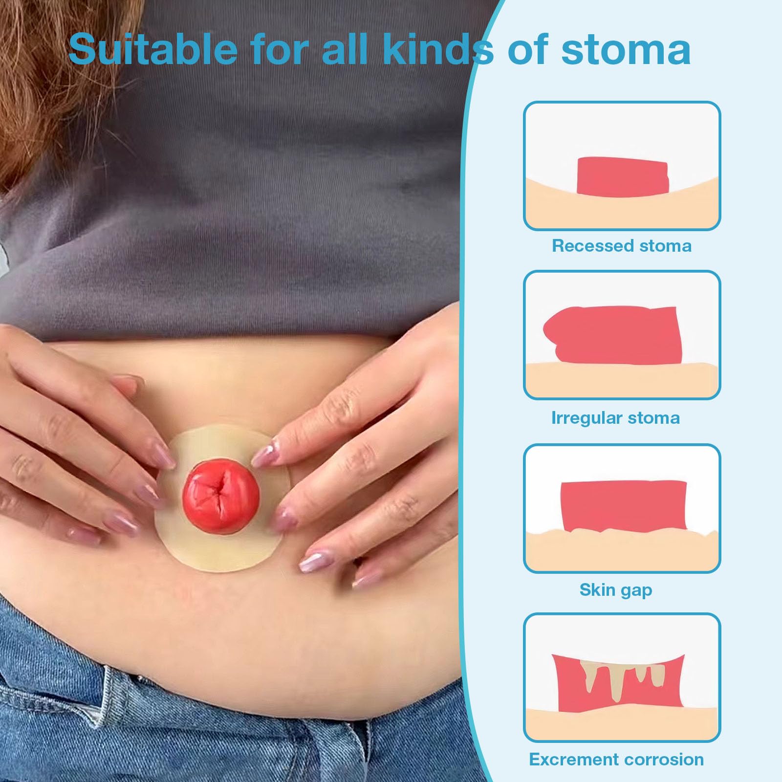 TNTNDAY 20PCS 4mm Moldable Ostomy Barrier Rings, Elastic Skin Extender Rings Outer Diameter 1.9Inch(48mm) Thickness, Medical Hyd