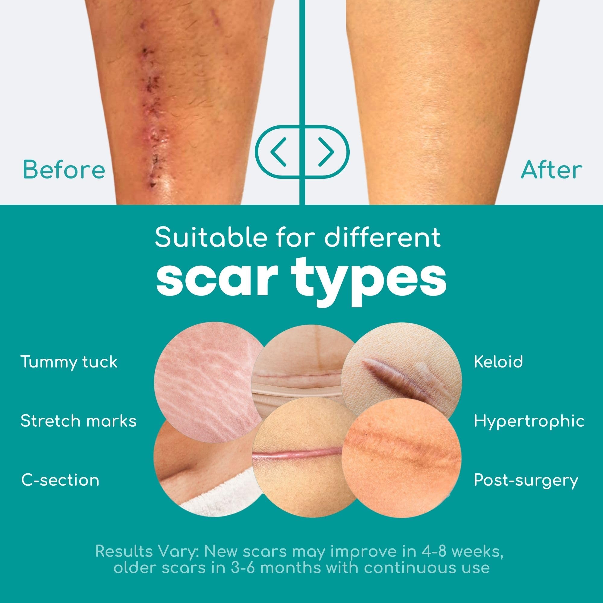 Medi Grade Silicone Scar Sheets, 80 Inches Long - Reusable Tape for C-Section, Keloid, Burn, Acne and Surgical Scars - Silicone