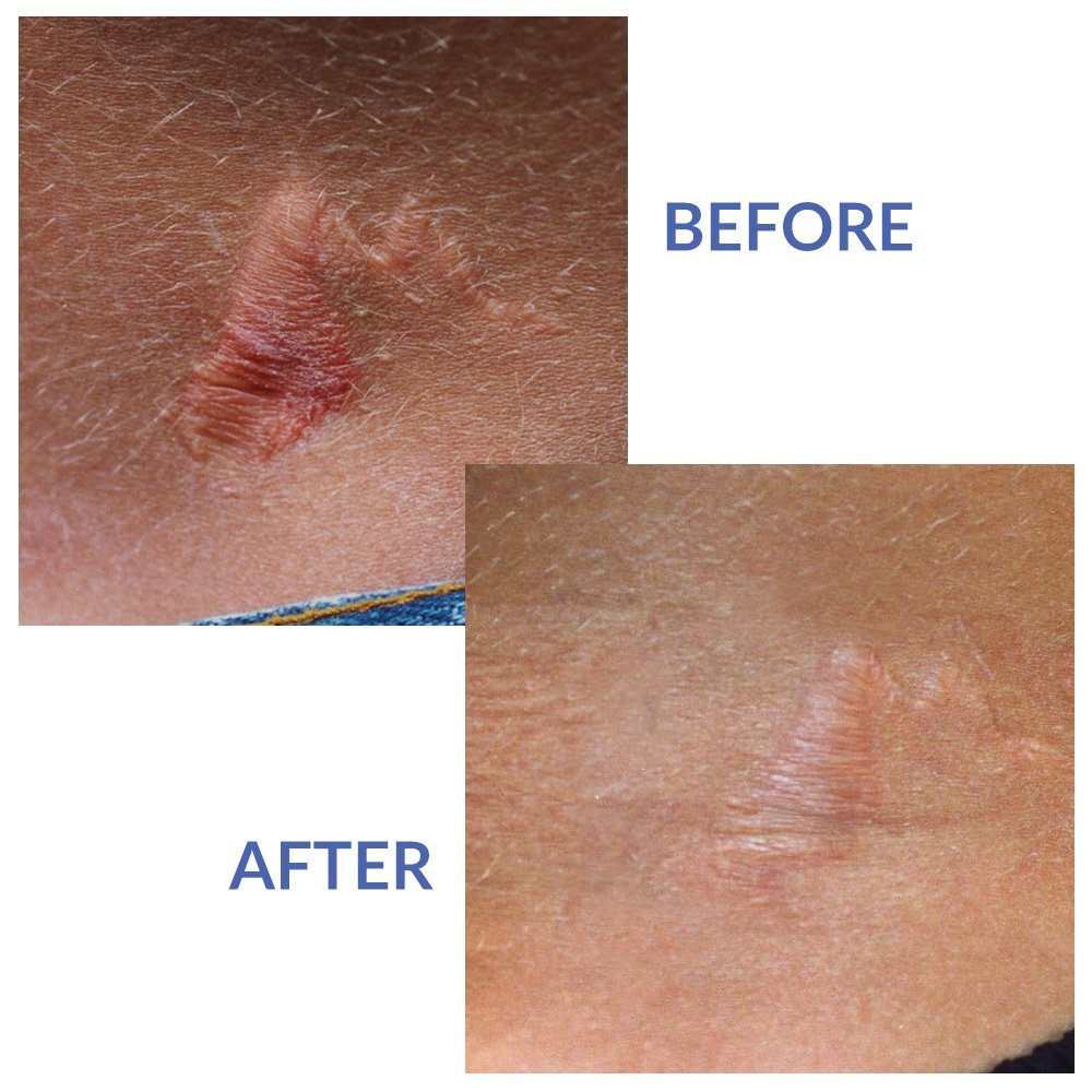 Xeragel 100% Silicone Scar Treatment Ointment - Clinically Proven to Reduce the Appearance of Old & New Scars - Sealed Tube, 10g