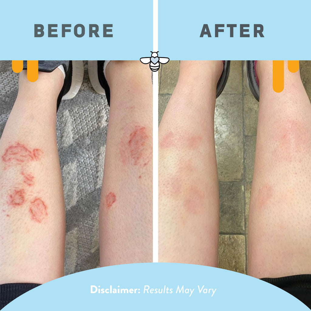 PSORIASIS HONEY Skin-Renewing Cream - Eczema & Seborrheic Dermatitis Cream - Psoriasis Treatment for Skin, Redness & Itch Relief