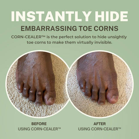 CORN-CEALER | Toe Corn Makeup | Instantly Hide Toe Corns | Concealer For Toe Corns (Shade-CHESTNUT)