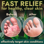 Terramed Just Think Comfort Foot Spray with Tea Tree Oil | Antifungal Treatment for Jock Itch, Nail Fungus & Ringworm | Fast Abs