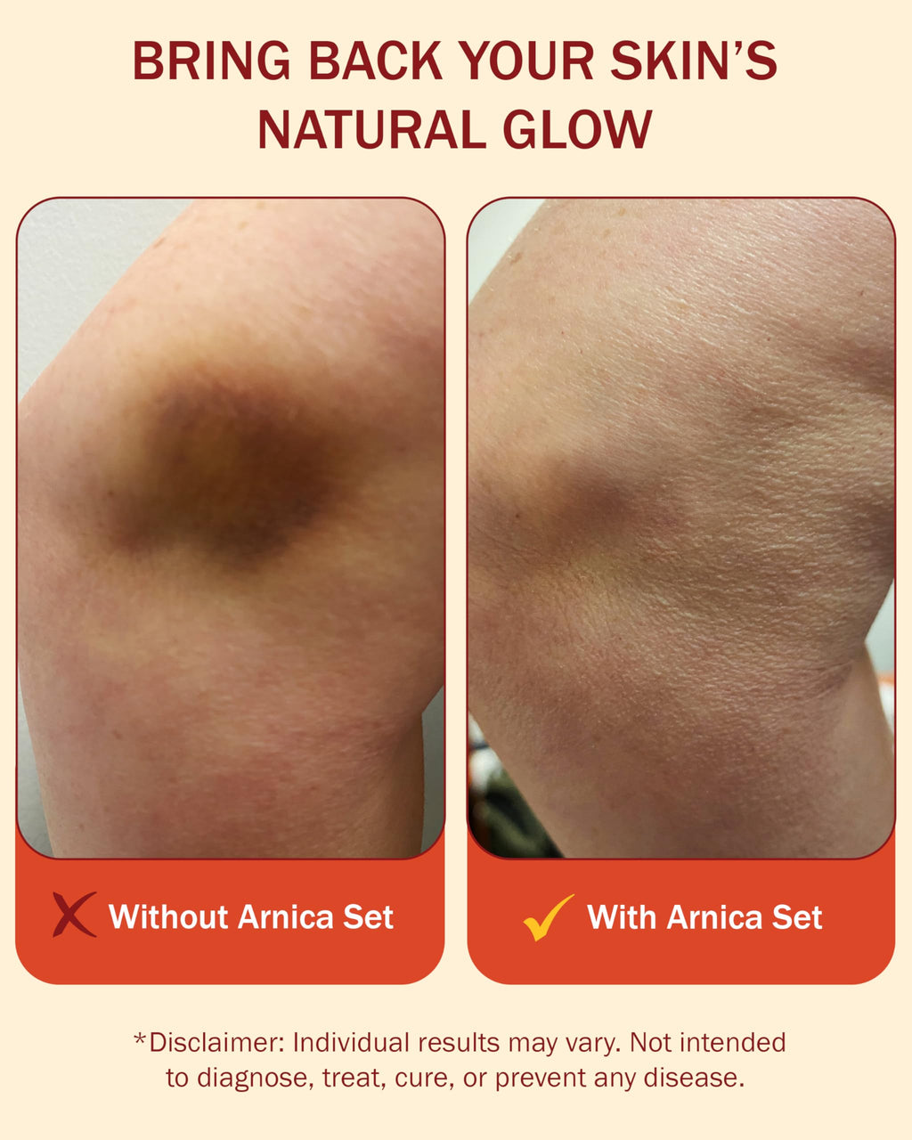 e70 Arnica Cream & Roll-On Set - 2-Piece Set Vitamin K Cream to Remove Bruises & Soothe Sore Muscles & Joints with 30% Arnica Mo