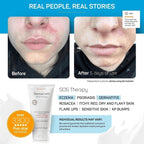 Clinically Tested DermaCalm SOS Therapy - Eczema Psoriasis Dermatitis Prone, Dry Skin - Urea 8%, Probiotics w/Best Natural Ingre